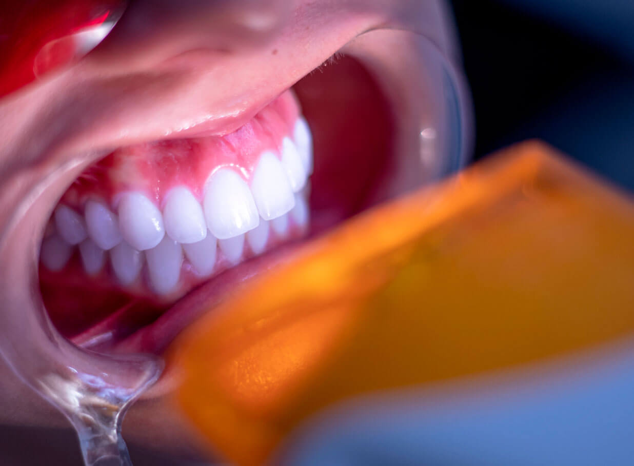 Blanqueamiento Dental en Medellín Unilaser