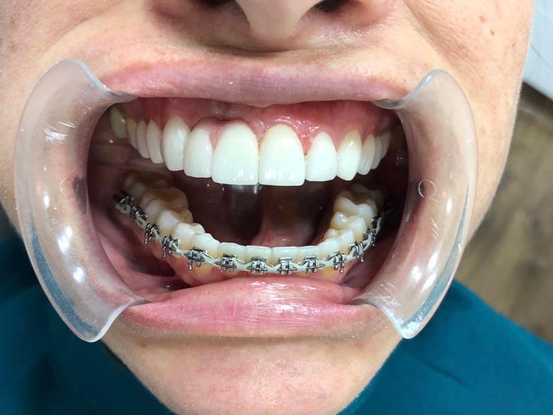 ubilaser-implantes-dentales-caso-pilar-c-1-1
