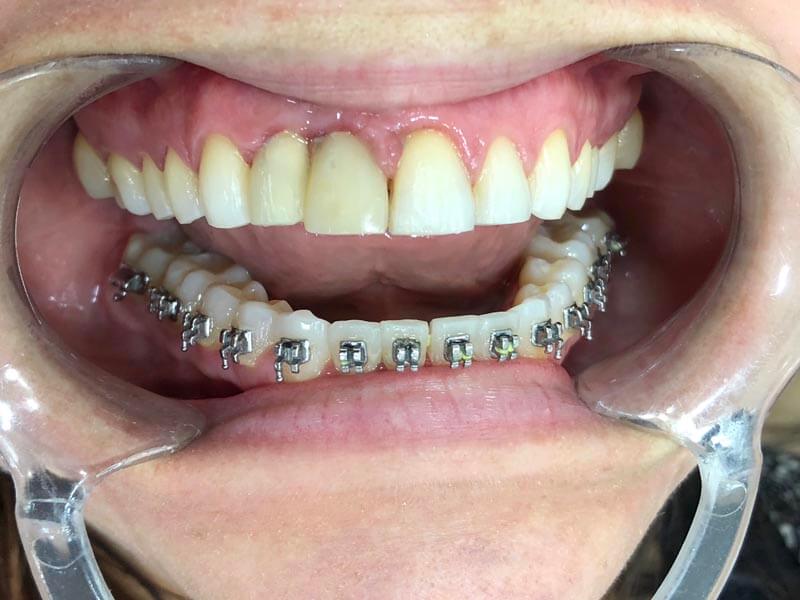 ubilaser-implantes-dentales-caso-pilar-c-1