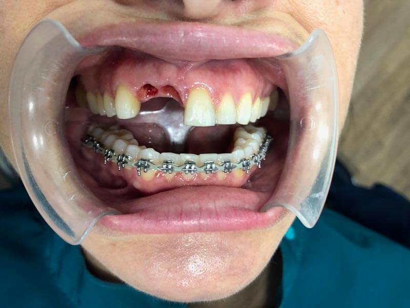 ubilaser-implantes-dentales-caso-pilar-c-2