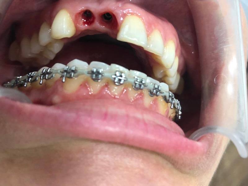 ubilaser-implantes-dentales-caso-pilar-c-3