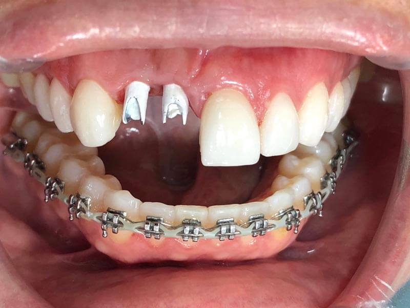 ubilaser-implantes-dentales-caso-pilar-c-4