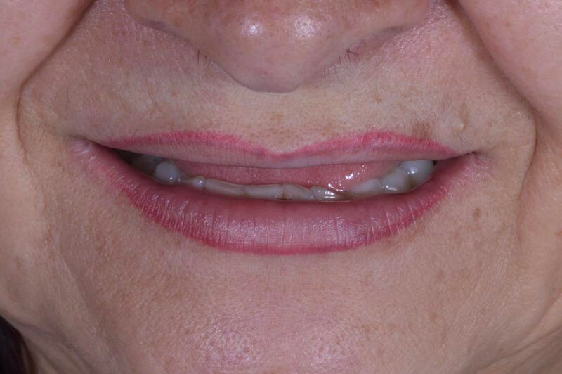 unilaser-implantes-dentales-caso-doris-a-1