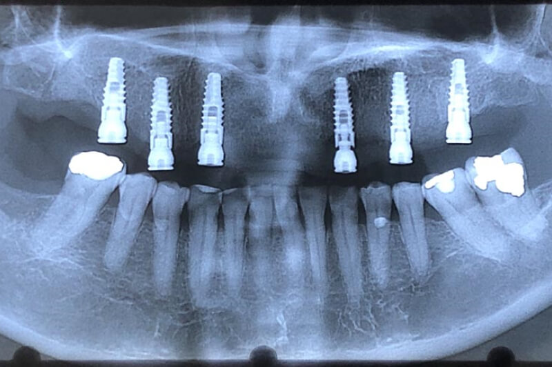 unilaser-implantes-dentales-caso-doris-a-2