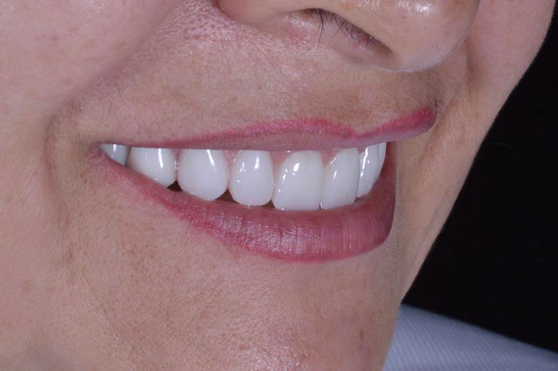 unilaser-implantes-dentales-caso-doris-a-3-1