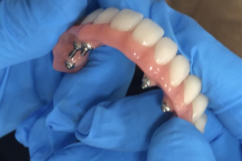 unilaser-implantes-dentales-caso-doris-a-4-1