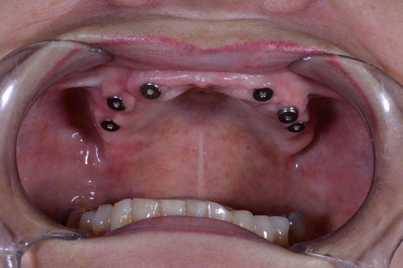 unilaser-implantes-dentales-caso-doris-a-4