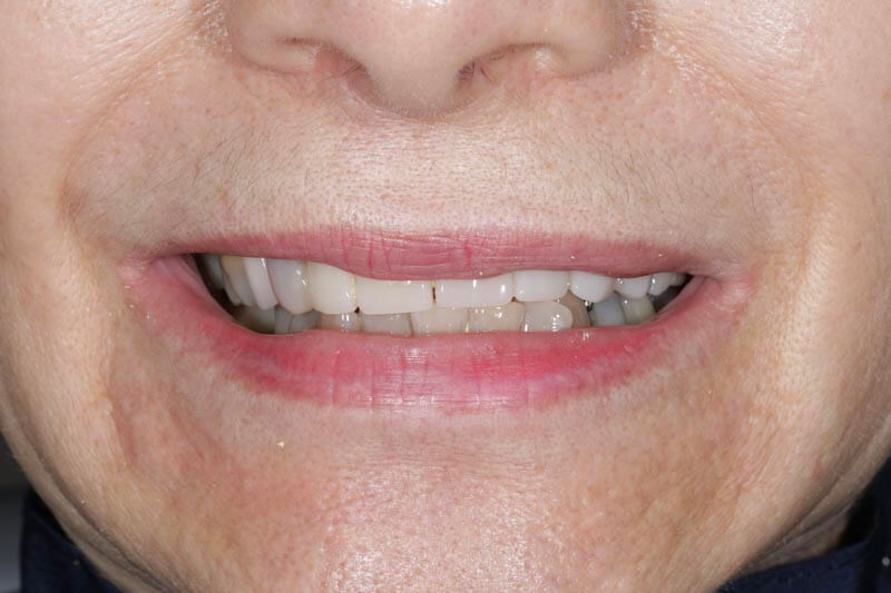 unilaser-implantes-dentales-caso-edilma-g-1
