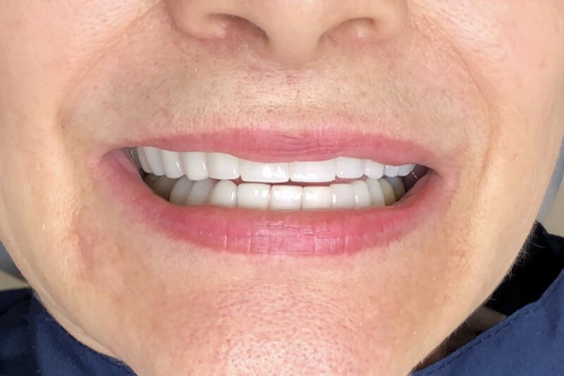 unilaser-implantes-dentales-caso-edilma-g-2-1