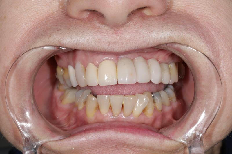 unilaser-implantes-dentales-caso-edilma-g-2