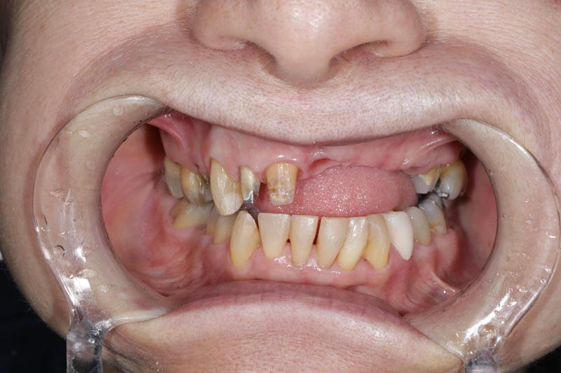 unilaser-implantes-dentales-caso-edilma-g-3