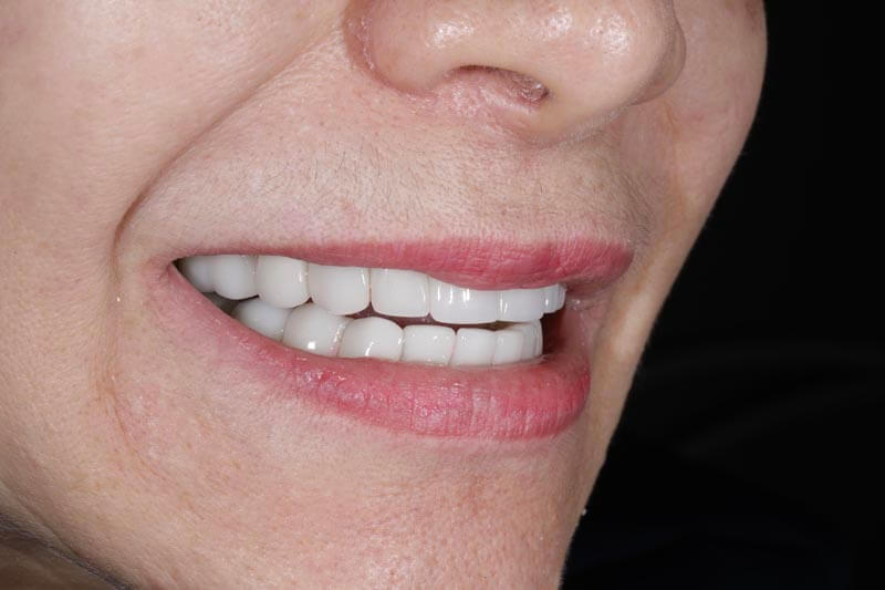 unilaser-implantes-dentales-caso-edilma-g-4-1
