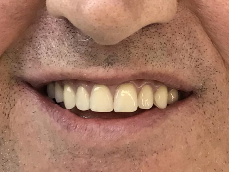 unilaser-implantes-dentales-caso-francisco-r-1-1