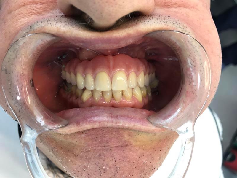 unilaser-implantes-dentales-caso-francisco-r-2-1