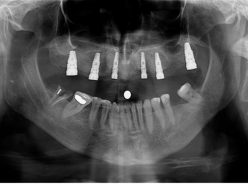 unilaser-implantes-dentales-caso-francisco-r-2