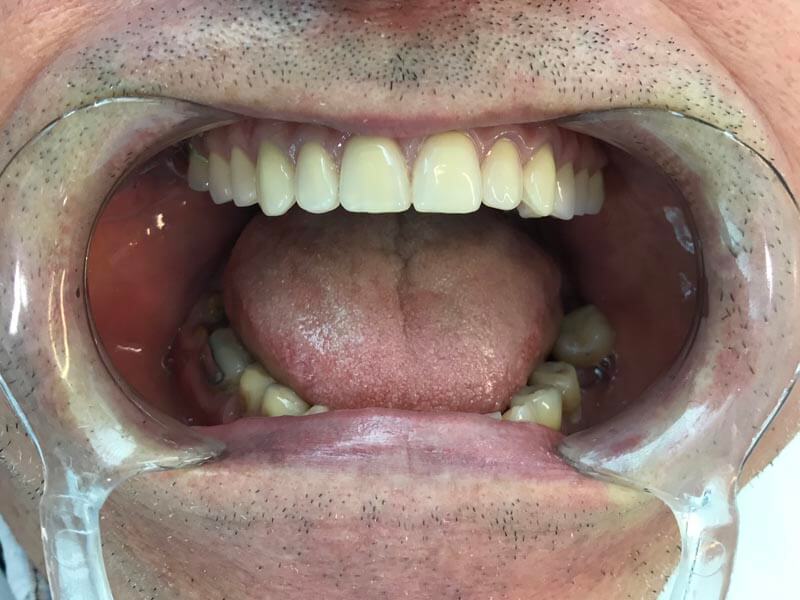 unilaser-implantes-dentales-caso-francisco-r-3-1