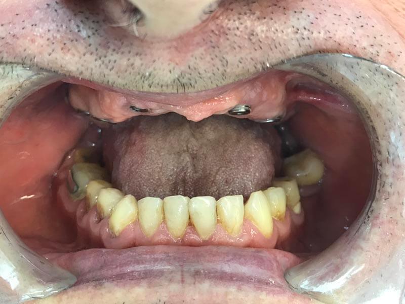 unilaser-implantes-dentales-caso-francisco-r-3