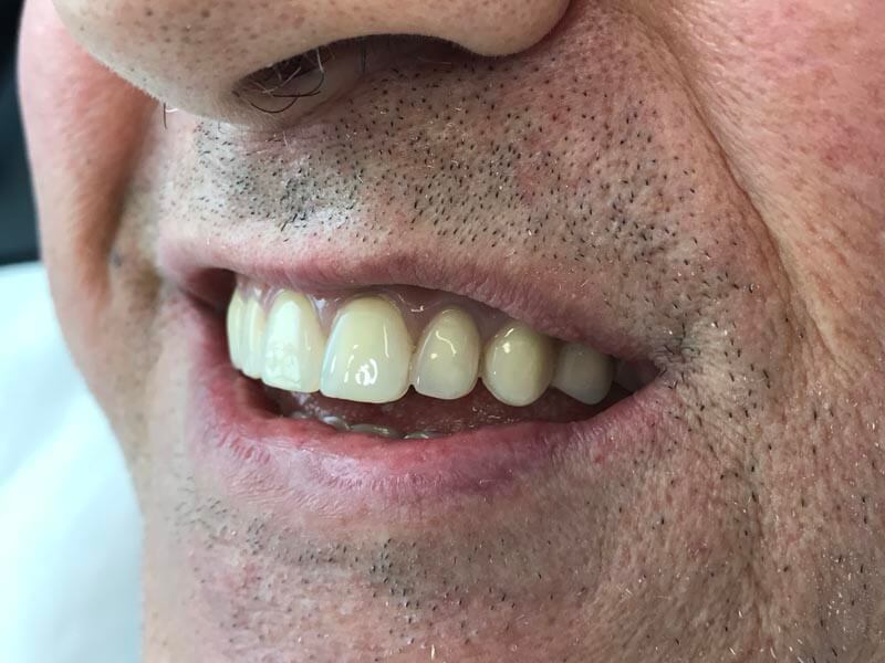 unilaser-implantes-dentales-caso-francisco-r-4-1