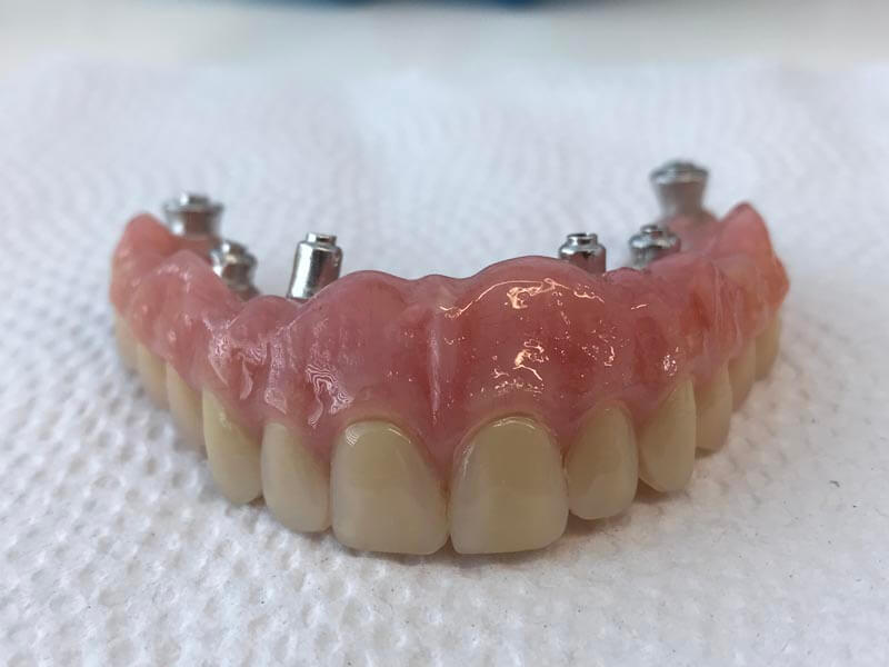 unilaser-implantes-dentales-caso-francisco-r-4