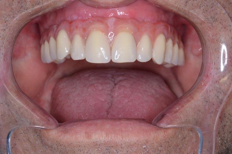 unilaser-implantes-dentales-caso-juan-c-1-1