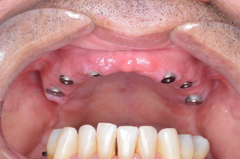 unilaser-implantes-dentales-caso-juan-c-2