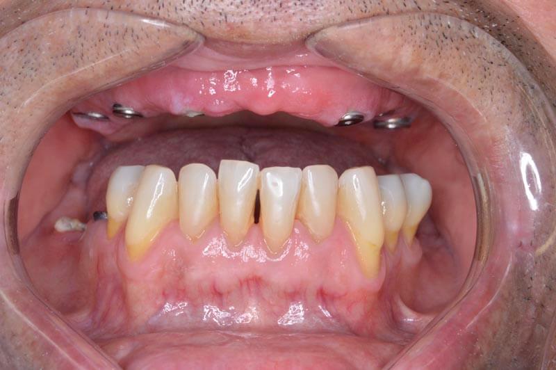 unilaser-implantes-dentales-caso-juan-c-3