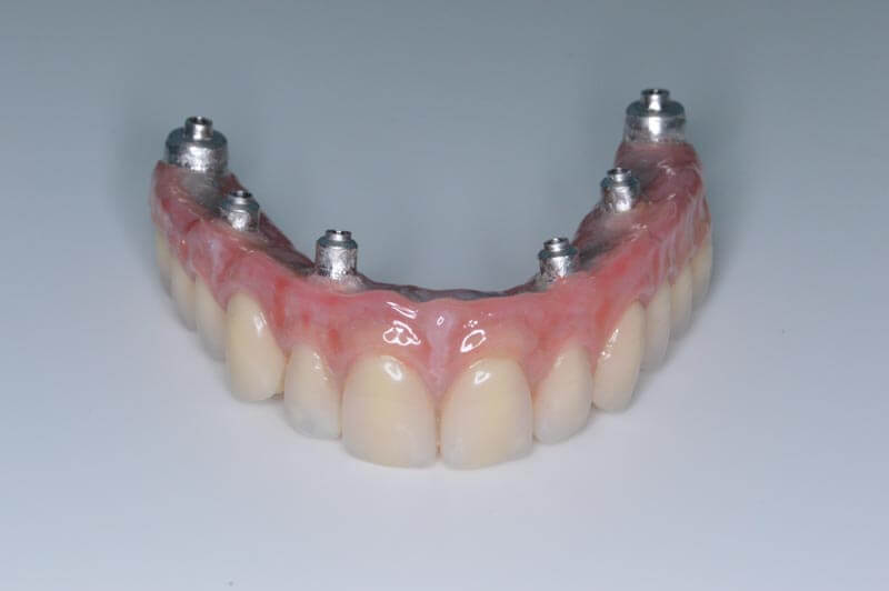 unilaser-implantes-dentales-caso-juan-c-4-1