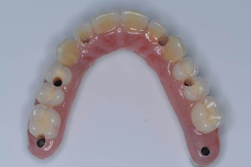 unilaser-implantes-dentales-caso-juan-c-4