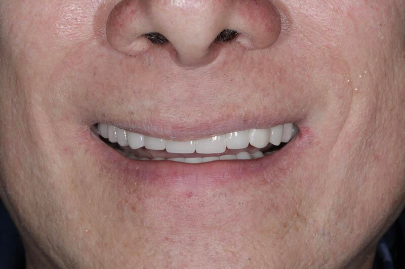 unilaser-implantes-dentales-caso-juan-m-1-1