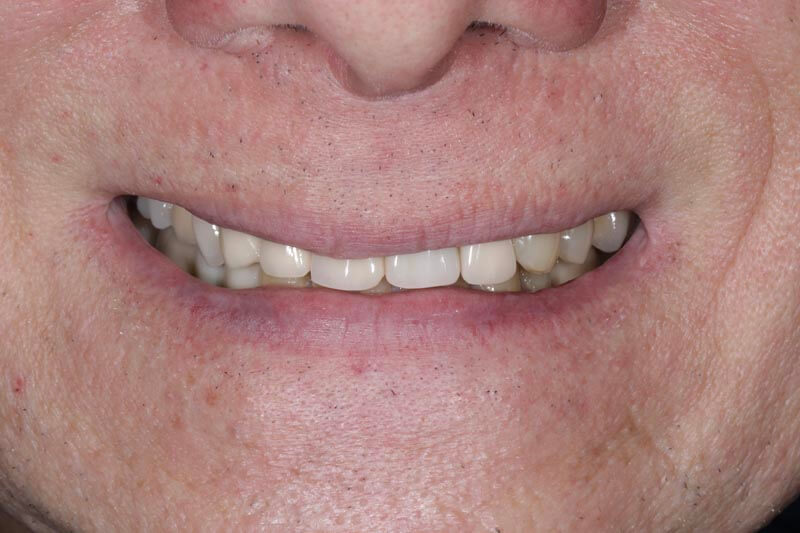 unilaser-implantes-dentales-caso-juan-m-1