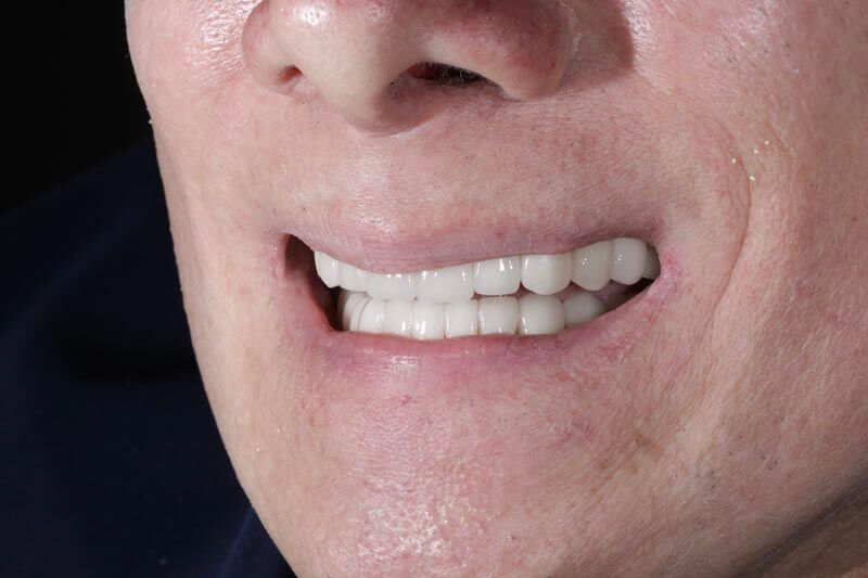 unilaser-implantes-dentales-caso-juan-m-2-1