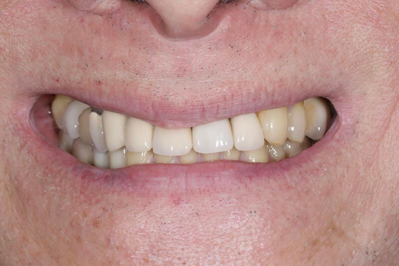 unilaser-implantes-dentales-caso-juan-m-2
