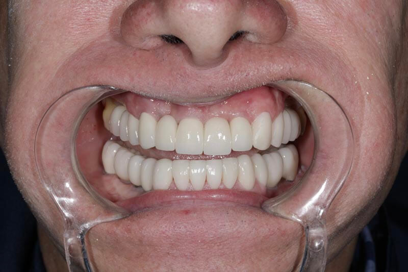 unilaser-implantes-dentales-caso-juan-m-3-1