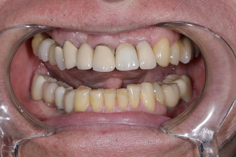 unilaser-implantes-dentales-caso-juan-m-3
