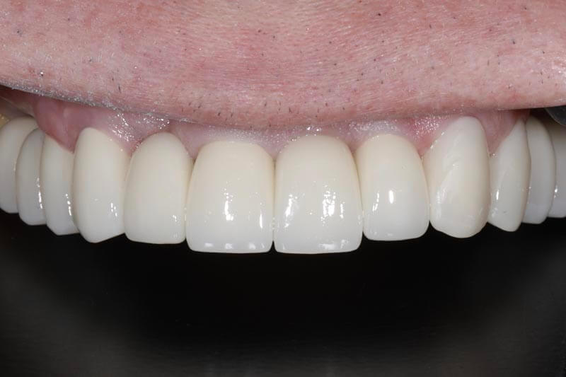 unilaser-implantes-dentales-caso-juan-m-4-1