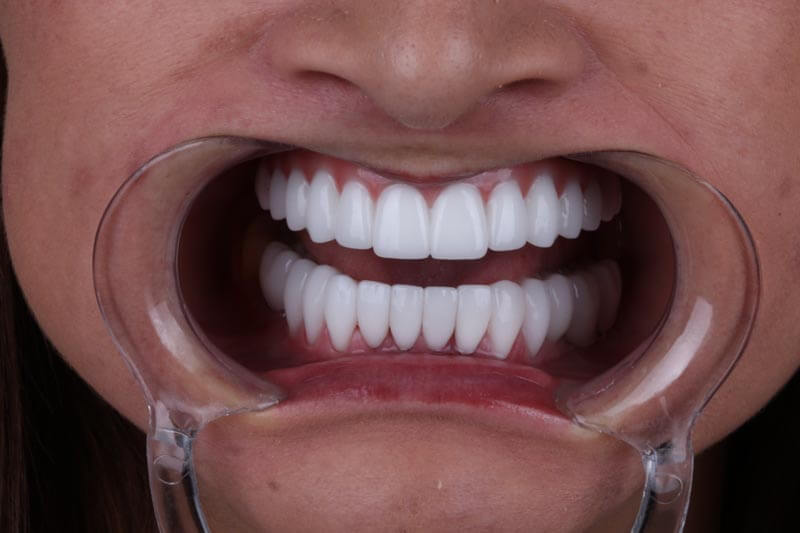unilaser-implantes-dentales-caso-luz-m-1-1