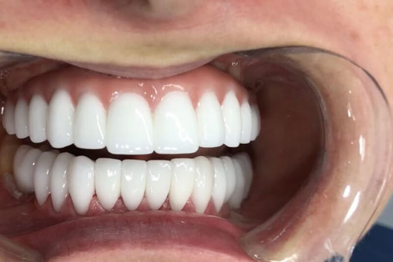 Implantes dentales fotos reales antes y después