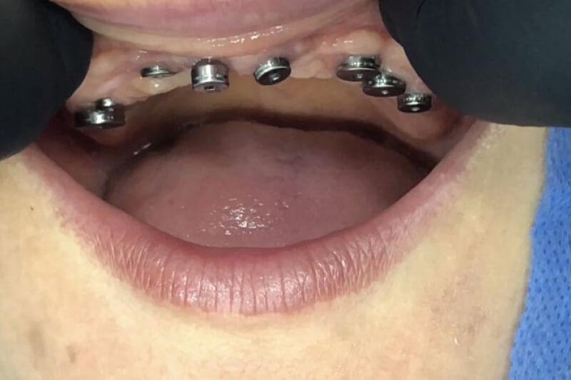 unilaser-implantes-dentales-caso-luz-m-2