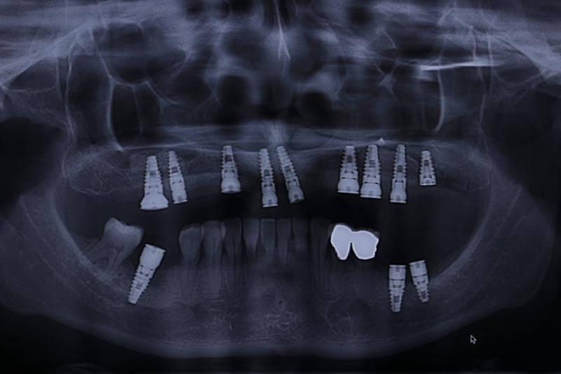 unilaser-implantes-dentales-caso-luz-m-3