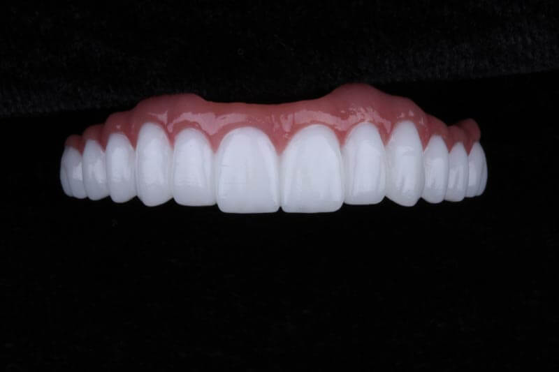 unilaser-implantes-dentales-caso-luz-m-4-1
