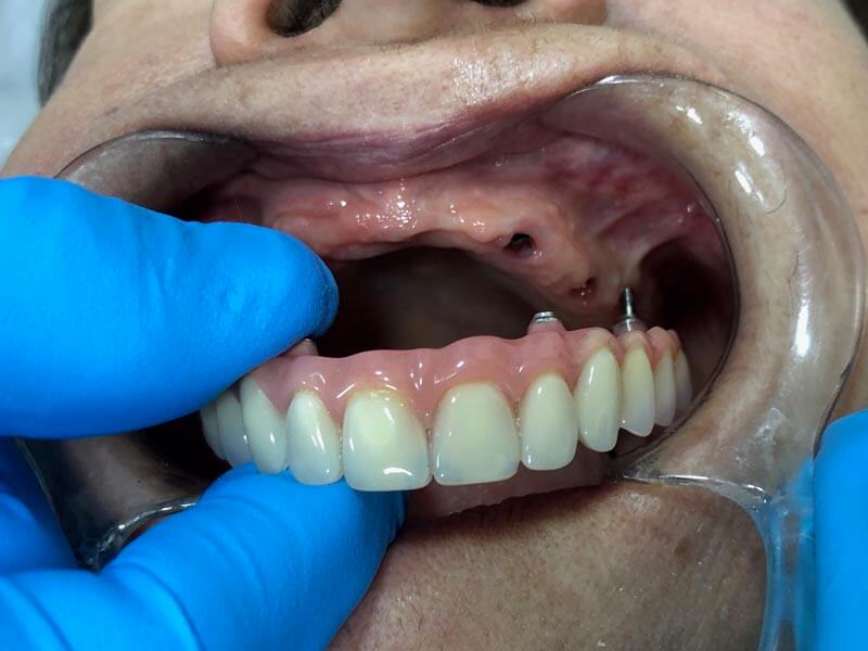 unilaser-implantes-dentales-caso-magdalena-p-2-1