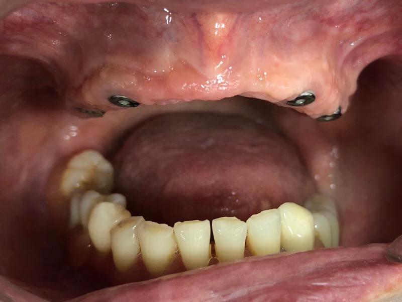 unilaser-implantes-dentales-caso-magdalena-p-2