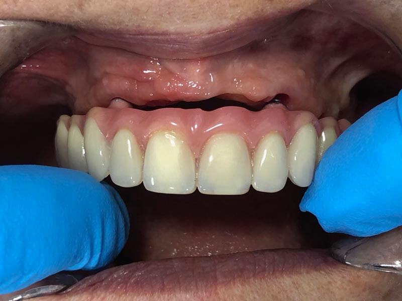 unilaser-implantes-dentales-caso-magdalena-p-3-1