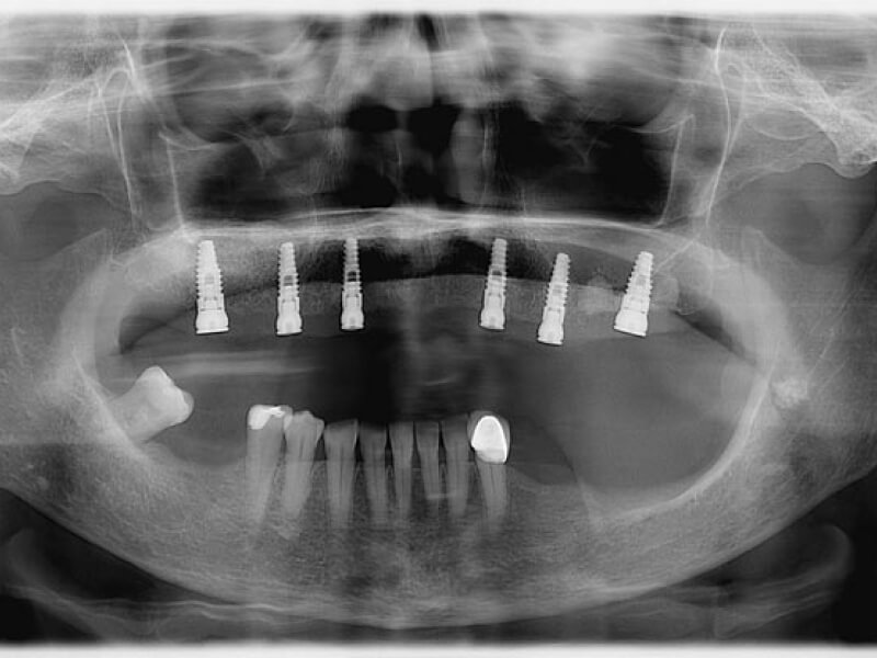 unilaser-implantes-dentales-caso-magdalena-p-3