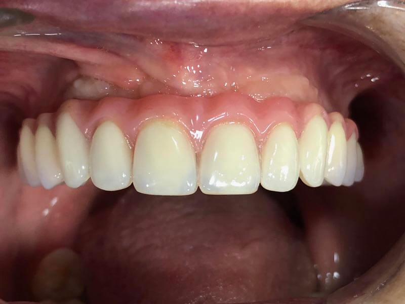 unilaser-implantes-dentales-caso-magdalena-p-4-1