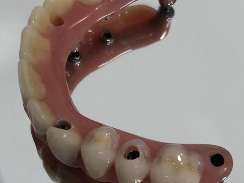 unilaser-implantes-dentales-caso-magdalena-p-4