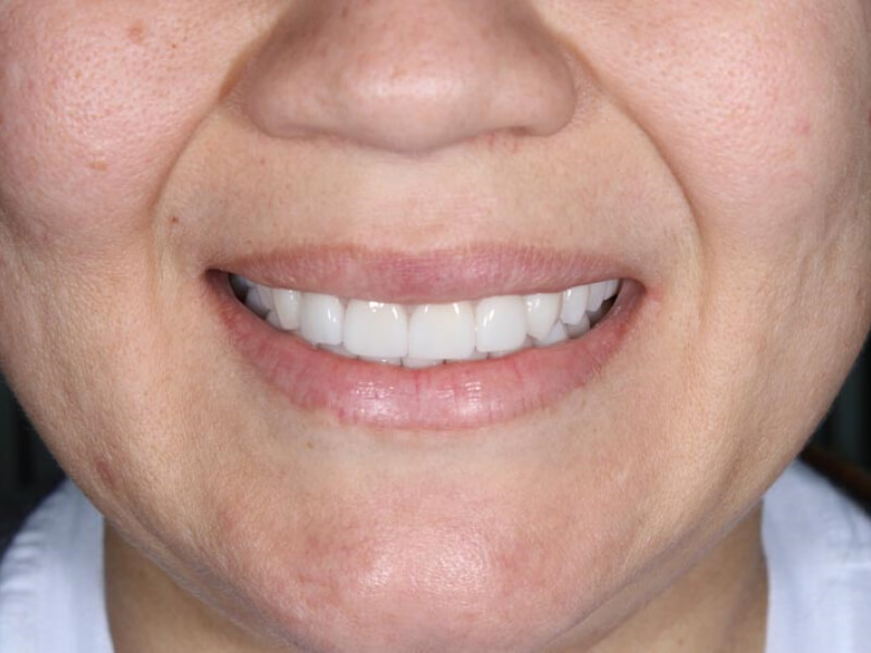 unilaser-implantes-dentales-caso-natalia-m-1-1