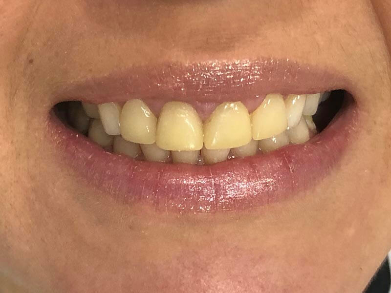 unilaser-implantes-dentales-caso-natalia-m-1