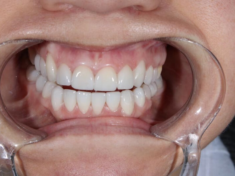 unilaser-implantes-dentales-caso-natalia-m-2-1