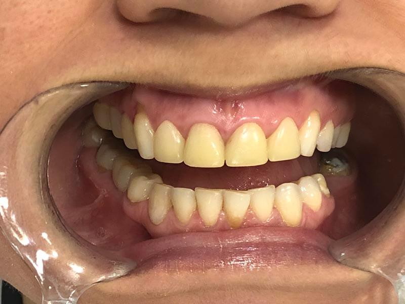 unilaser-implantes-dentales-caso-natalia-m-2
